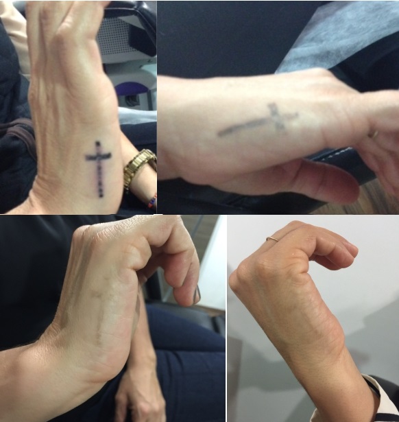 Los tatuajes suelen ser removidos diez años después de su realización