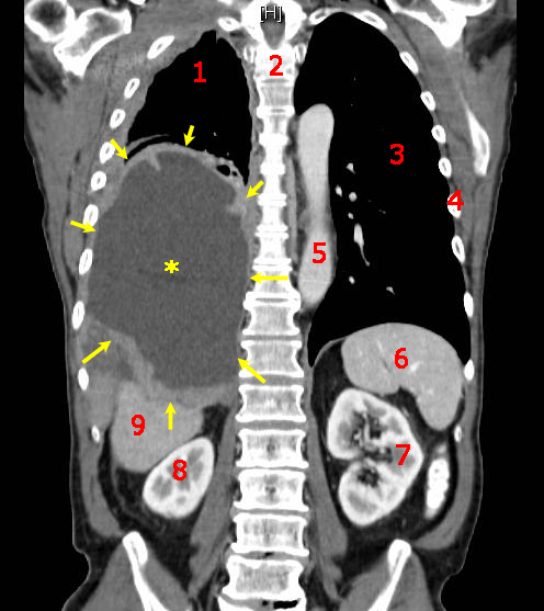 Cáncer de mesotelio (señalado por flechas amarillas).